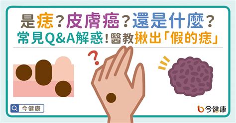 臉上突然長痣怎麼辦|是痣？皮膚癌？還是什麼？常見Q&A解惑！醫教揪出「。